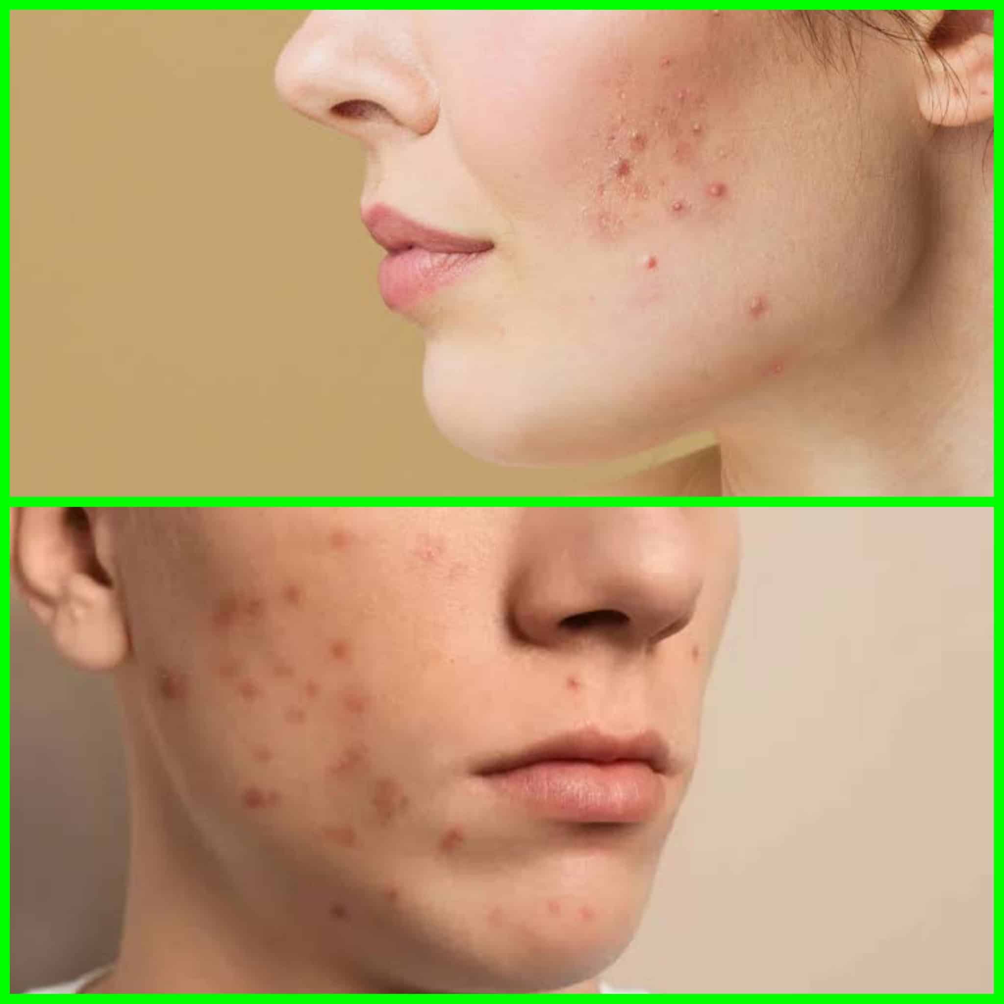ব্রণ ও মুখের দাগ